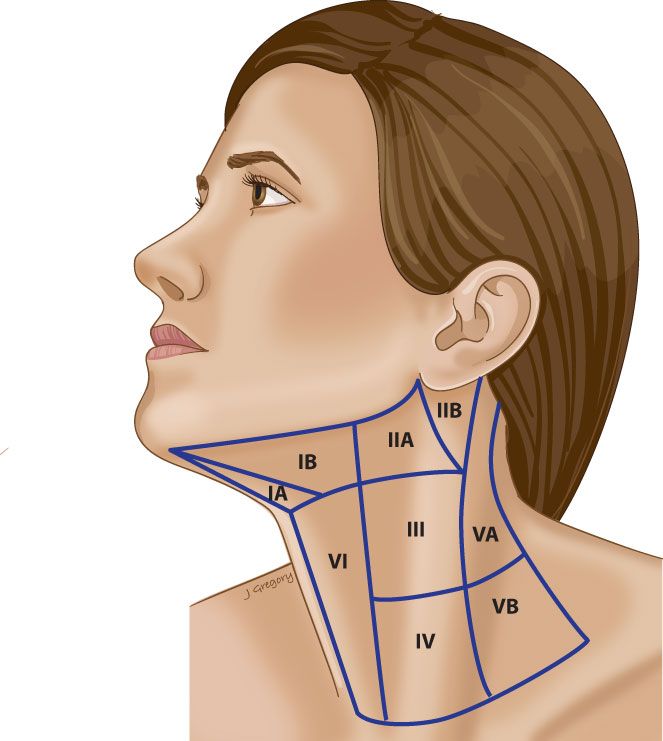 Neck Dissection Explained: What Gets Removed, What Doesn't, and What Recovery Feels Like