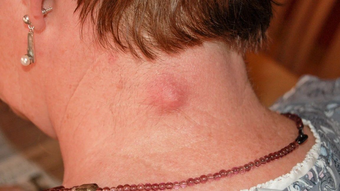 Painless Lump in the Neck: When It's Nothing and When to See a Specialist