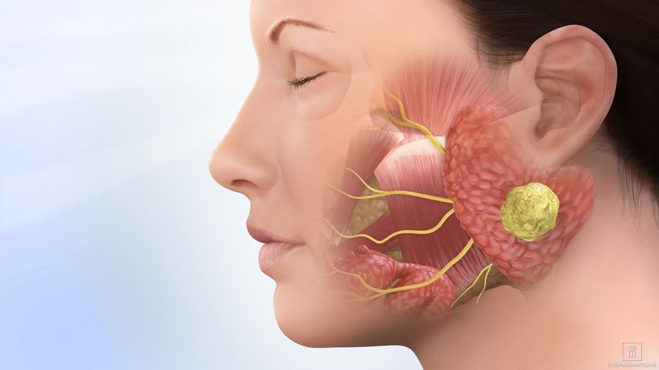 Salivary Gland Surgery
