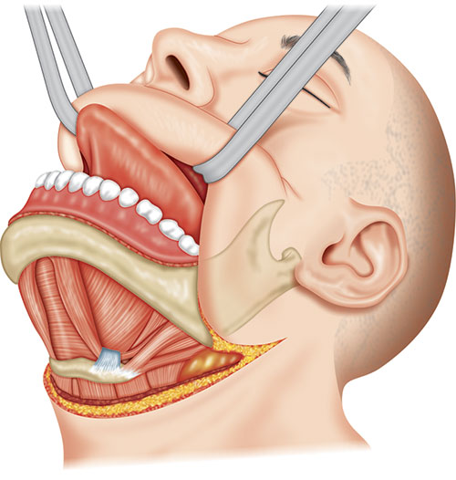 Composite Resection Surgery in Delhi NCR - Dr. Karan Gupta