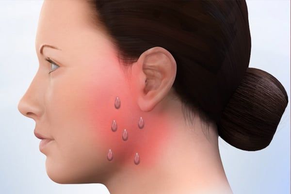 Parotid Tumor Surgery with Facial Nerve Preservation in Delhi NCR