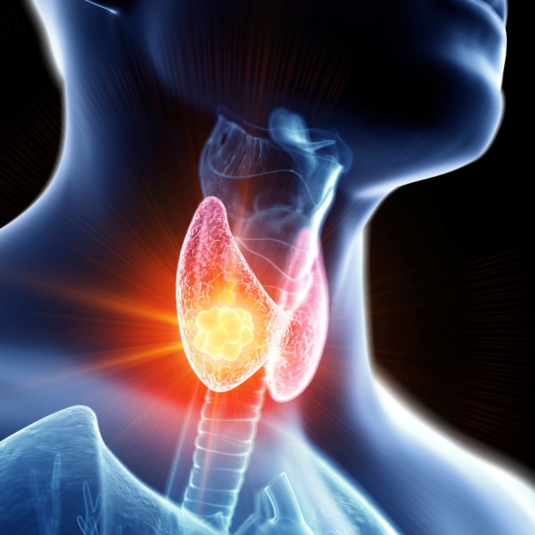 Thyroid Cancer Surgery in Delhi NCR - Dr. Karan Gupta
